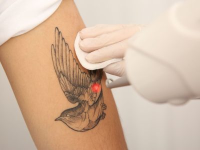 Comprehensive Guide to Tattoo Removal: Benefits and Process 